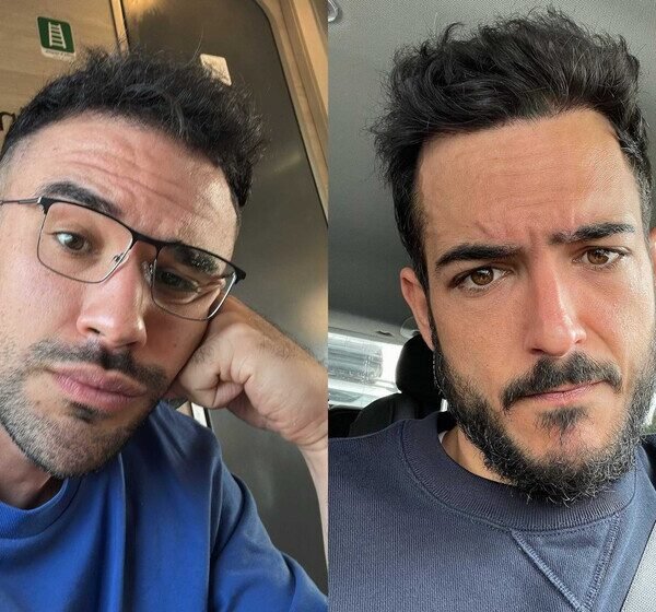 Un experto en trasplantes capilares desvela la controversia…