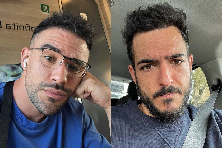 Un experto en trasplantes capilares desvela la controversia sobre IlloJuan y su nuevo injerto capilar